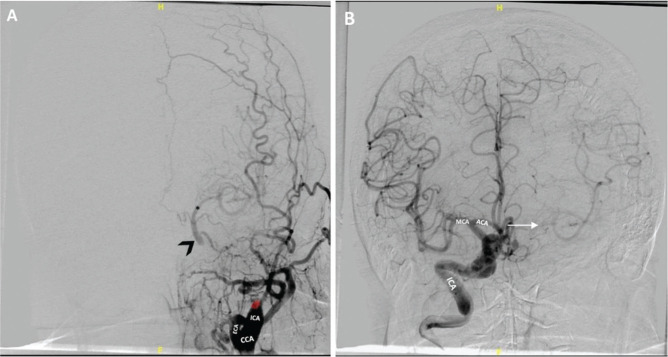 Spontaneous thrombosis of a giant cavernous-carotid aneurysm with simultaneous ipsilateral complete parent artery occlusion: a rare phenomenon and review of the literature.