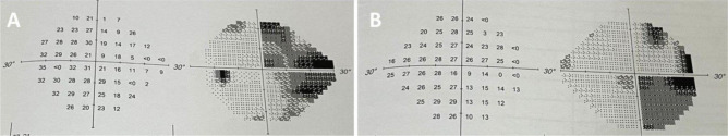 Spontaneous thrombosis of a giant cavernous-carotid aneurysm with simultaneous ipsilateral complete parent artery occlusion: a rare phenomenon and review of the literature.