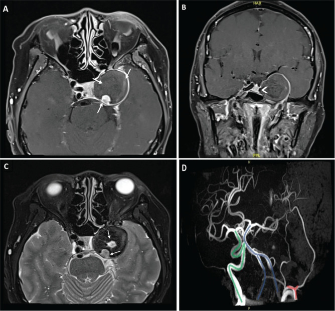 Spontaneous thrombosis of a giant cavernous-carotid aneurysm with simultaneous ipsilateral complete parent artery occlusion: a rare phenomenon and review of the literature.