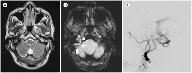 Comparison of Single- and Multi-Echo Susceptibility-Weighted Imaging in Detecting Cerebral Arteriovenous Shunts: A Preliminary Study.