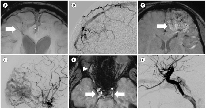 Comparison of Single- and Multi-Echo Susceptibility-Weighted Imaging in Detecting Cerebral Arteriovenous Shunts: A Preliminary Study.