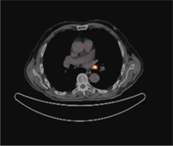 Pros and cons of an aggressive initial treatment with surgery and radioiodine treatment in minimally invasive follicular thyroid carcinoma.