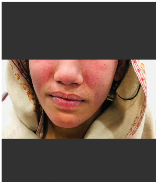 Diagnostic Dilemma of ANA-negative Pediatric Systemic Lupus Erythematosus in a South Asian Female.