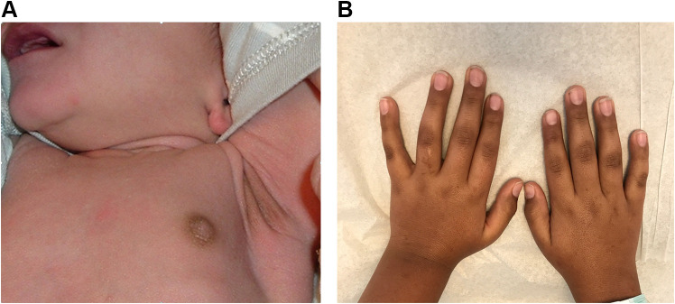 Current Screening Strategies for the Diagnosis of Adrenal Insufficiency in Children.