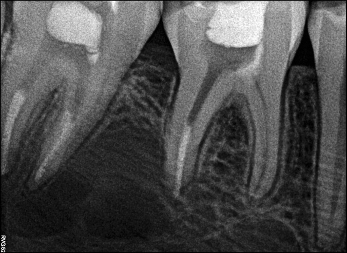 Successful treatment of cystic lesion combining Cystectomy, Nonsurgical Endodontics and Vital Pulp Therapy of Mature Permanent Mandibular Molars: a Case Report with 19 Months Follow-Up.