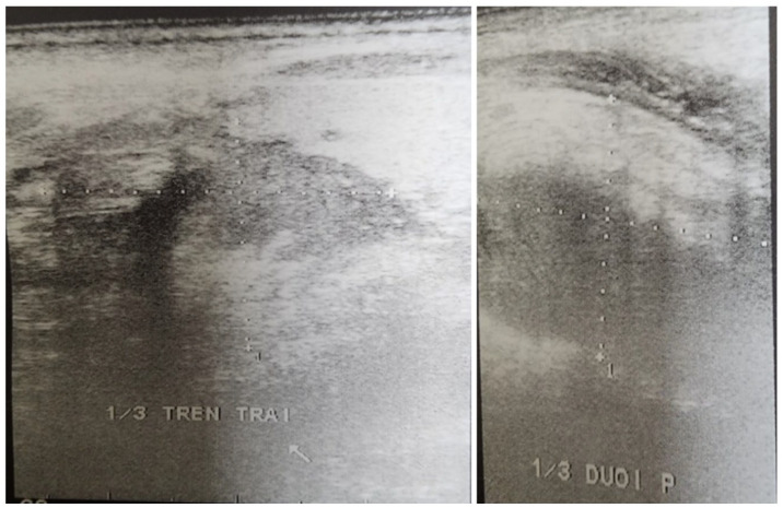 Secondary Mediastinal Bleeding Caused by Parathyroid Adenocarcinoma: A Case Report.