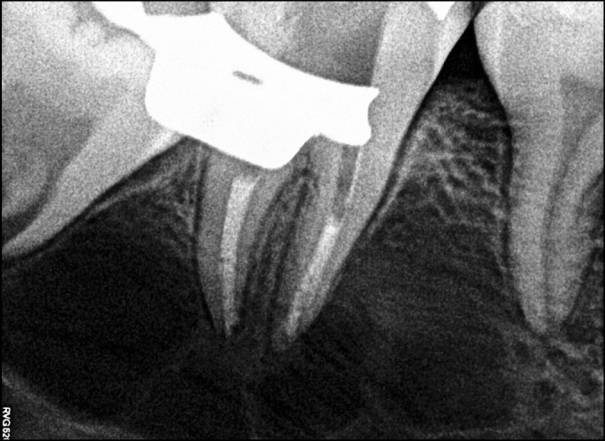 Successful treatment of cystic lesion combining Cystectomy, Nonsurgical Endodontics and Vital Pulp Therapy of Mature Permanent Mandibular Molars: a Case Report with 19 Months Follow-Up.