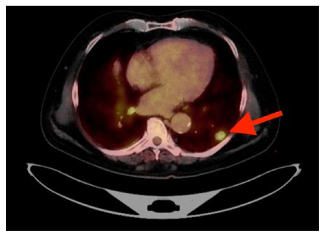 Clear Cell Renal Carcinoma Presents as a Solitary Pulmonary Nodule Fifteen Years After Nephrectomy.