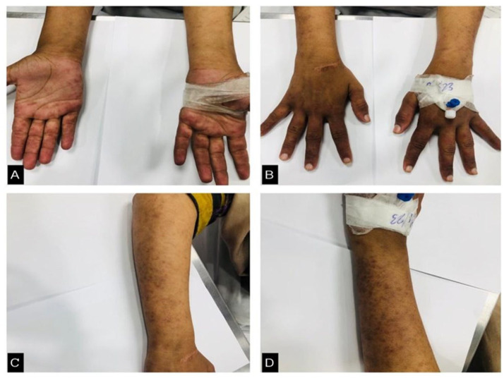 Diagnostic Dilemma of ANA-negative Pediatric Systemic Lupus Erythematosus in a South Asian Female.