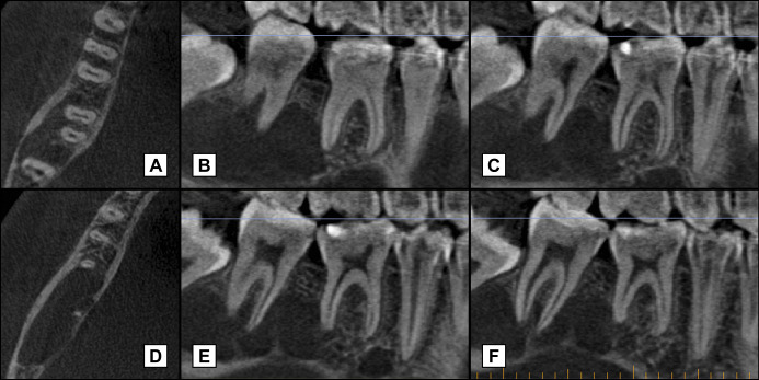 Successful treatment of cystic lesion combining Cystectomy, Nonsurgical Endodontics and Vital Pulp Therapy of Mature Permanent Mandibular Molars: a Case Report with 19 Months Follow-Up.