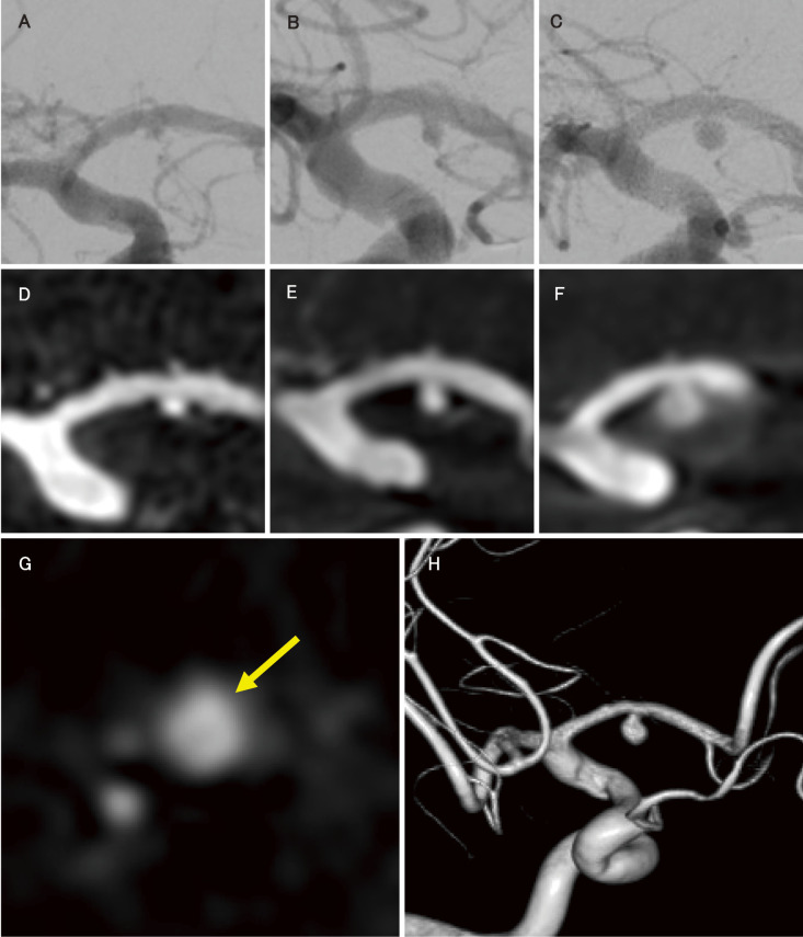 Internal Trapping of a Growing Ruptured Dissecting Aneurysm of the A1 Segment: A Case Report and Literature Review.