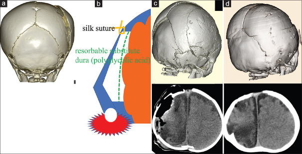 Inverted gull-wing hinge decompressive craniotomy for infantile acute subdural hematoma: A case report.