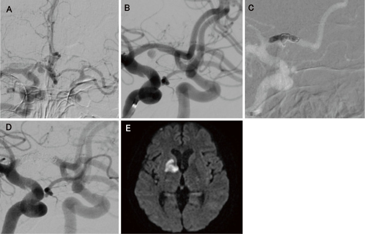 Internal Trapping of a Growing Ruptured Dissecting Aneurysm of the A1 Segment: A Case Report and Literature Review.