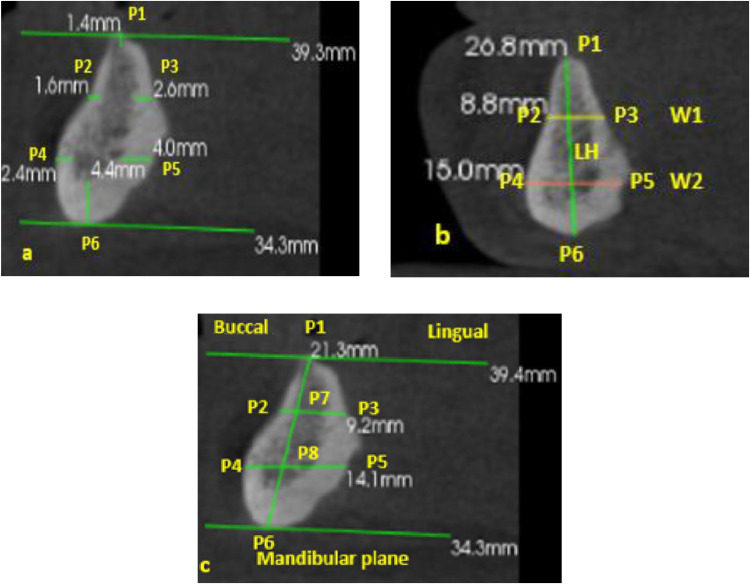 CBCT Analysis of Edentulous Mandibular Symphysis in Iraqi Patients for Treatment with Implant-Supported Overdentures. Cross-Sectional Single-Center Study.