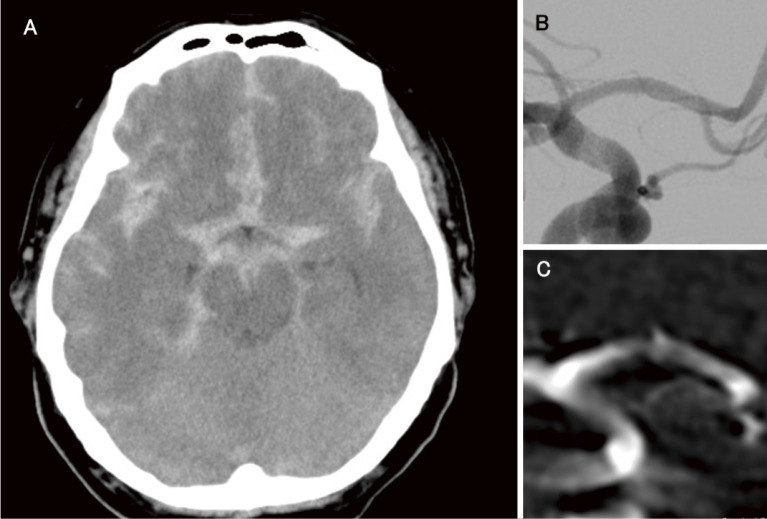 Internal Trapping of a Growing Ruptured Dissecting Aneurysm of the A1 Segment: A Case Report and Literature Review.