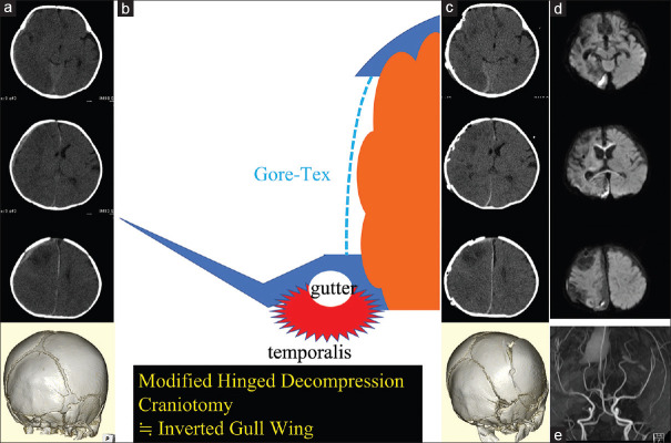 Inverted gull-wing hinge decompressive craniotomy for infantile acute subdural hematoma: A case report.