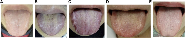 Objective evaluation of tongue diagnosis ability using a tongue diagnosis e-learning/e-assessment system based on a standardized tongue image database.