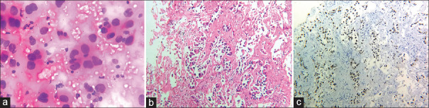 Role of Bronchoscopic Cytology in Diagnosis of Pulmonary Lesions.