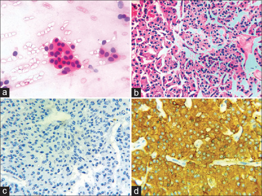 Role of Bronchoscopic Cytology in Diagnosis of Pulmonary Lesions.