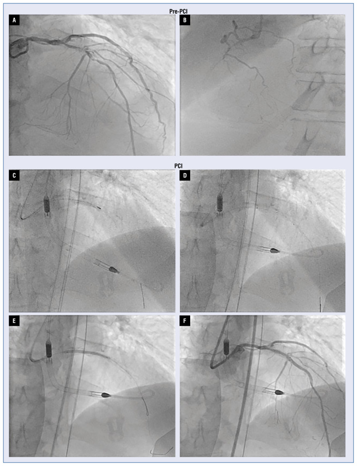 Impella-rota-shock percutaneous coronary intervention: Three weapons, one last remaining vessel.