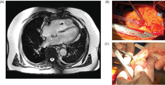 Delayed Cardiac Metastasis from Renal Cell Carcinoma Caused by <i>VHL</i> Mutation.