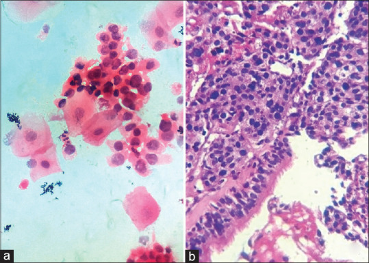 Role of Bronchoscopic Cytology in Diagnosis of Pulmonary Lesions.