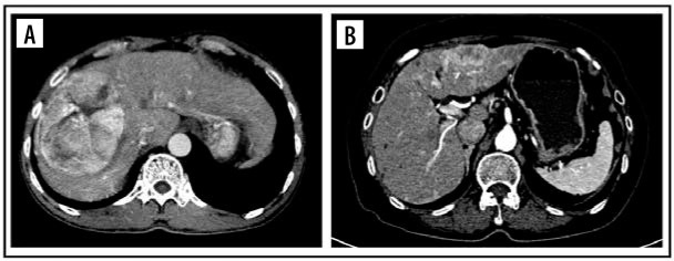 Prediction microvascular invasion of hepatocellular carcinoma based on tumour margin enhancing pattern in multiphase computed tomography images.