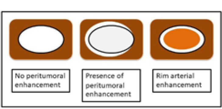 Prediction microvascular invasion of hepatocellular carcinoma based on tumour margin enhancing pattern in multiphase computed tomography images.