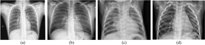 COVID-19 and pneumonia diagnosis from chest X-ray images using convolutional neural networks.