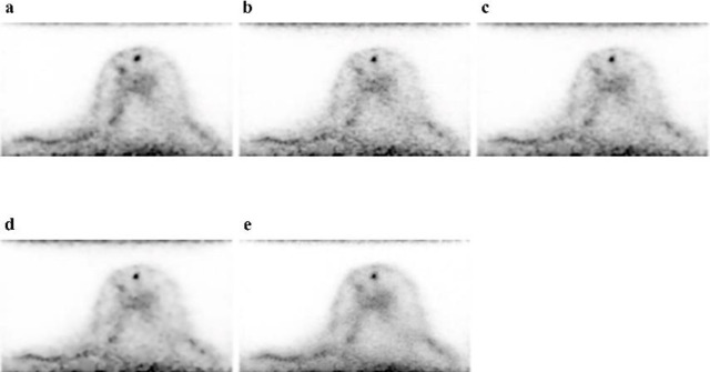 Feasibility of Dedicated Breast Positron Emission Tomography Image Denoising Using a Residual Neural Network.