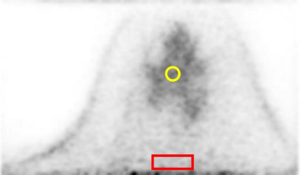 Feasibility of Dedicated Breast Positron Emission Tomography Image Denoising Using a Residual Neural Network.