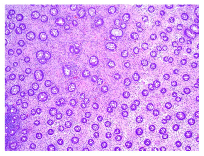 Colonic Ganglioneuroma: A Rare Incidental Finding.