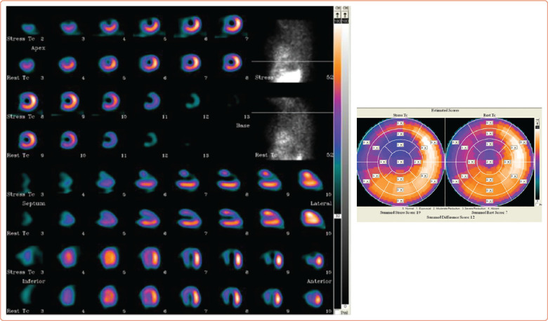 Cancer and Postradiotherapy Cardiotoxicity: How to Face Damage in Women's Hearts?