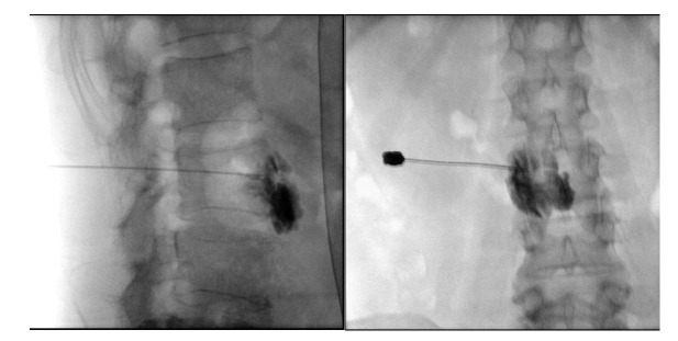 Cauda equina syndrome by extrusion of lumbar disc after lumbar sympathetic neurolysis.