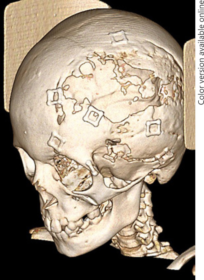 Considerations for Choice of Cranioplasty Material for Pediatric Patients.