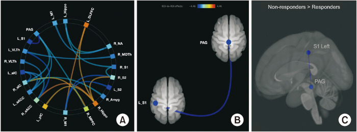 Primary somatosensory cortex and periaqueductal gray functional connectivity as a marker of the dysfunction of the descending pain modulatory system in fibromyalgia.