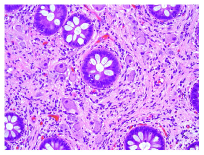 Colonic Ganglioneuroma: A Rare Incidental Finding.