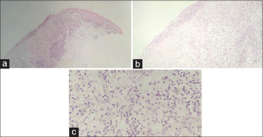 Malignant syphilis in an immunocompromised female: A case report from Northeast India.