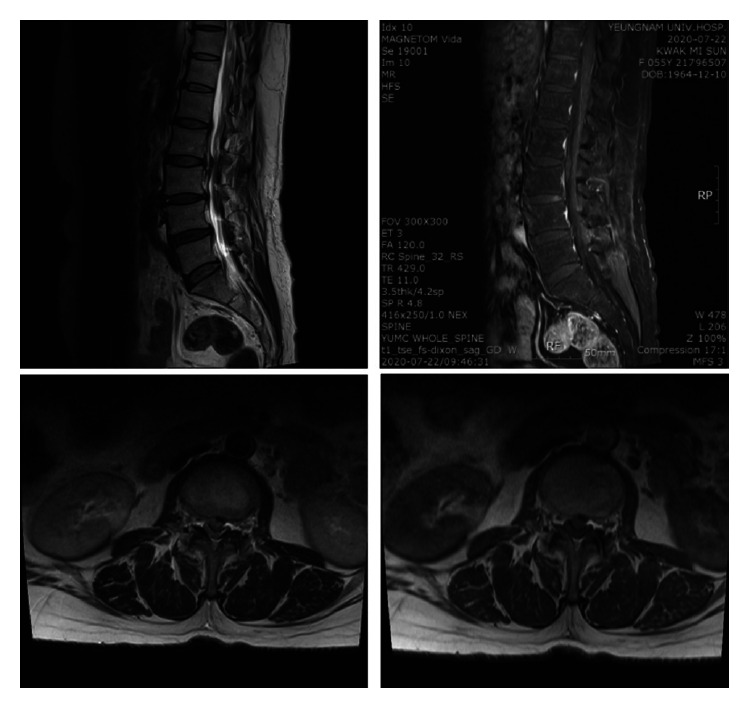 Cauda equina syndrome by extrusion of lumbar disc after lumbar sympathetic neurolysis.