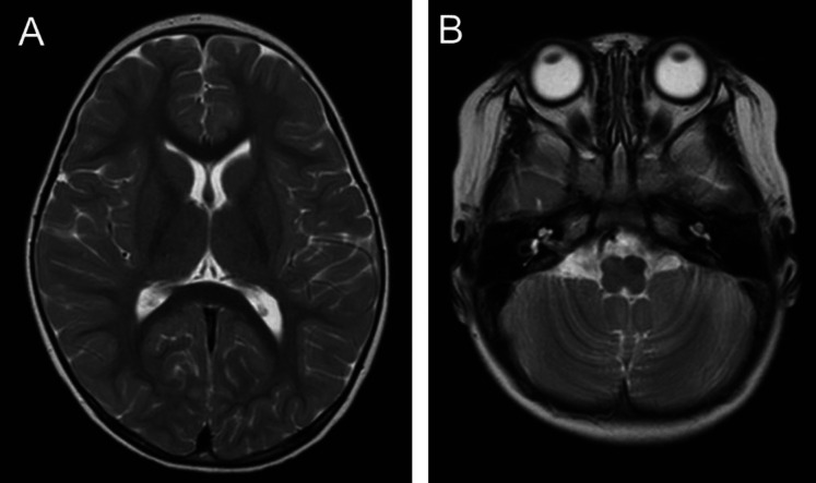 Neuroblastoma-related severe hypoperfusion in the cerebellum of an infant: A case of opsoclonus-myoclonus syndrome.