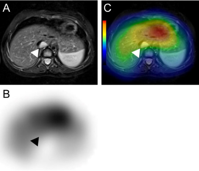 Neuroblastoma-related severe hypoperfusion in the cerebellum of an infant: A case of opsoclonus-myoclonus syndrome.