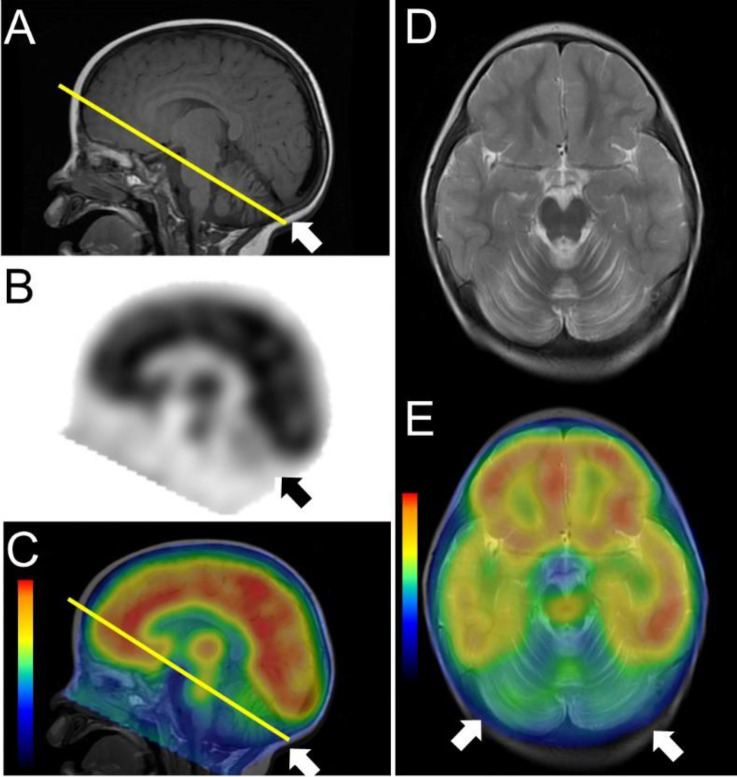 Neuroblastoma-related severe hypoperfusion in the cerebellum of an infant: A case of opsoclonus-myoclonus syndrome.