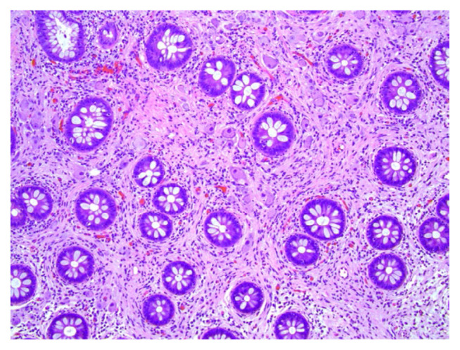 Colonic Ganglioneuroma: A Rare Incidental Finding.