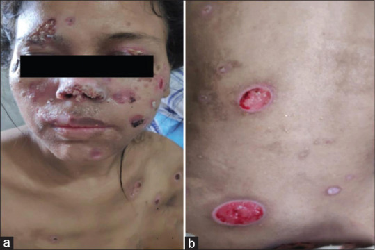 Malignant syphilis in an immunocompromised female: A case report from Northeast India.