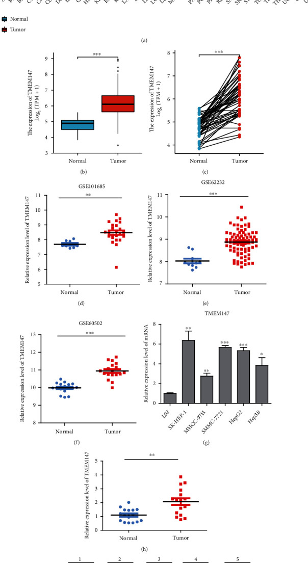 TMEM147 Correlates with Immune Infiltration and Serve as a Potential Prognostic Biomarker in Hepatocellular Carcinoma.