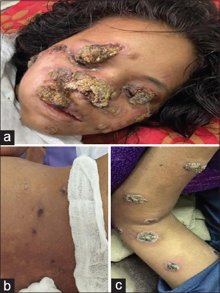 Malignant syphilis in an immunocompromised female: A case report from Northeast India.