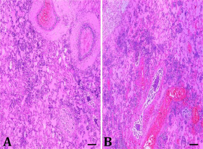 Histopathological lesions of <i>Actinobacillus pleuropneumoniae</i> serotype 8 in infected pigs.