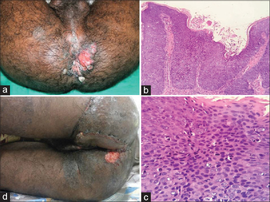 An unusual presentation of perianal Bowen's disease in an immunocompromised patient - Excised and grafted.