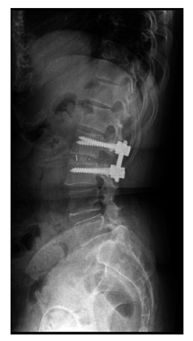 Cauda equina syndrome by extrusion of lumbar disc after lumbar sympathetic neurolysis.