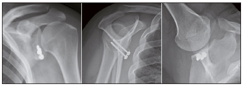 TREATMENT OF RECURRENT ANTERIOR SHOULDER DISLOCATION USING THE LATARJET TECHNIQUE.